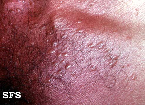 File:Syringoma (Dermatology Atlas 4).jpg