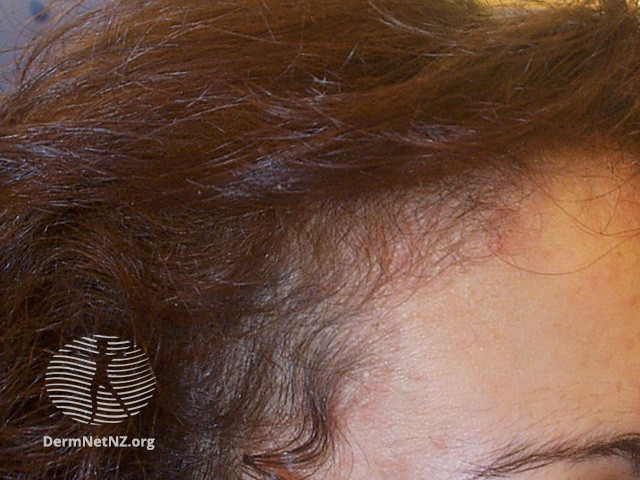 File:Telogen effluvium (DermNet NZ hair-nails-sweat-telogen-loss).jpg