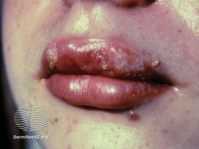File:(DermNet NZ herpes-simplex-labialis-56).jpg