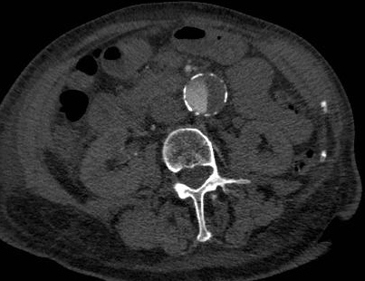 File:Abdominal aortic aneurysm- yin-yang sign (Radiopaedia 17111).jpg