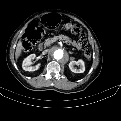 Abdominal aortic aneurysm (Radiopaedia 67117-76452 Axial C+ arterial phase 52).jpg