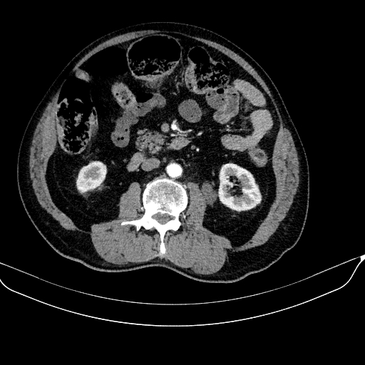 Abdominal aortic aneurysm (Radiopaedia 67117-76452 Axial C+ arterial phase 66).jpg