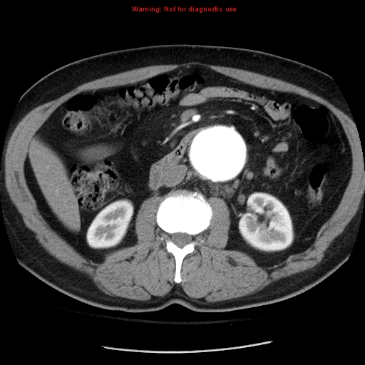 File:Abdominal aortic aneurysm (Radiopaedia 8190-9038 Axial C+ arterial phase 37).jpg