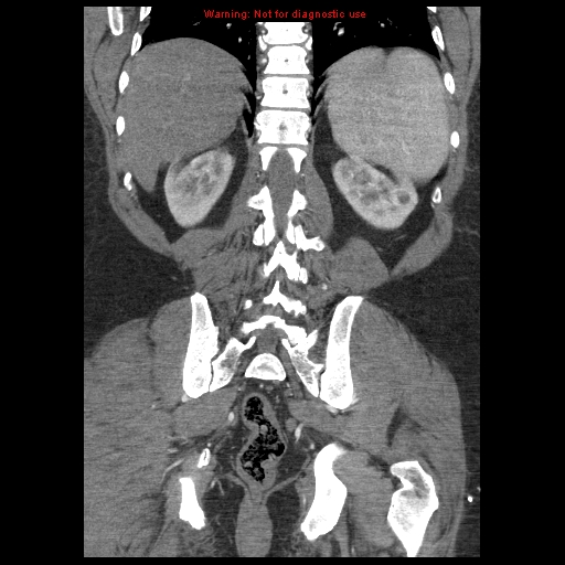 Abdominal aortic aneurysm (Radiopaedia 8190-9038 Coronal C+ arterial phase 98).jpg