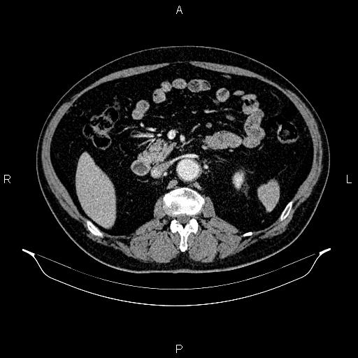 Abdominal aortic aneurysm (Radiopaedia 83094-97462 Axial renal cortical phase 90).jpg