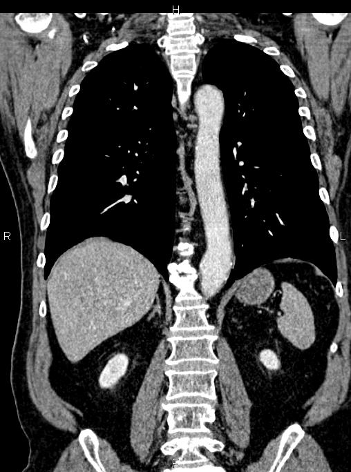 Abdominal aortic aneurysm (Radiopaedia 83094-97462 Coronal renal cortical phase 62).jpg