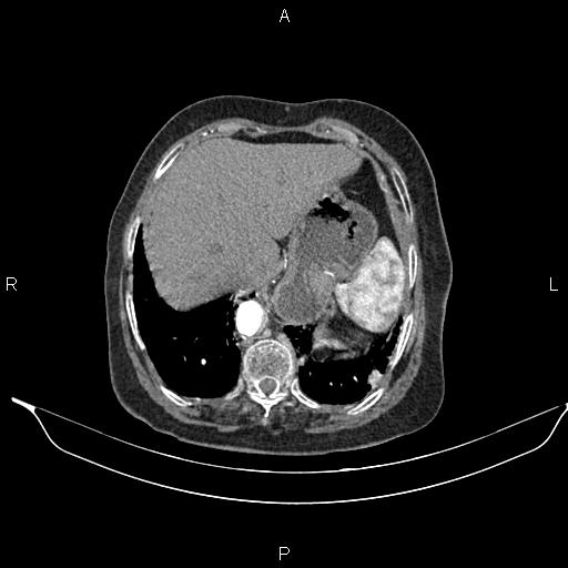File:Abdominal aortic aneurysm (Radiopaedia 85063-100606 Axial C+ arterial phase 28).jpg
