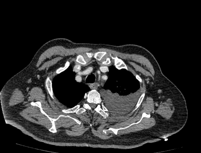 Abdominal aortic aneurysm rupture (Radiopaedia 54179-60362 Axial C+ portal venous phase 51).jpg