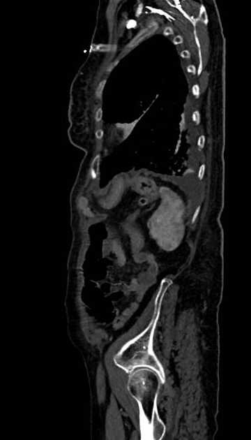 Abdominal aortic aneurysm with thrombus fissuration (Radiopaedia 73192-83919 Sagittal C+ arterial phase 17).jpg