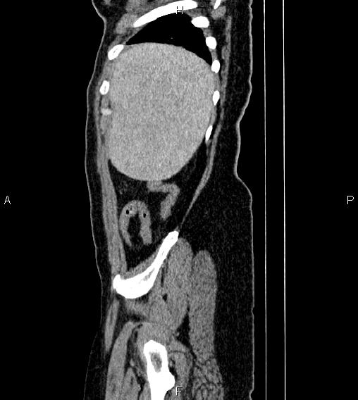 Abdominal lymphoma with sandwich sign (Radiopaedia 84378-99704 Sagittal C+ portal venous phase 83).jpg