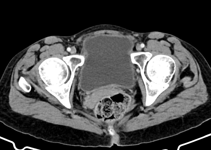 Abdominal wall and retroperitoneal tuberculosis (Radiopaedia 88137-104729 Axial C+ portal venous phase 182).jpg