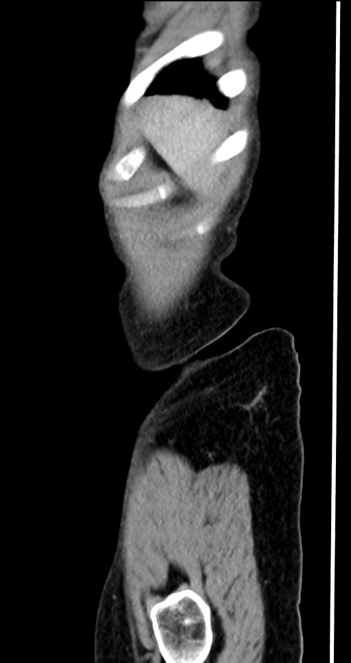 Abdominal wall and retroperitoneal tuberculosis (Radiopaedia 88137-104729 Sagittal C+ portal venous phase 15).jpg