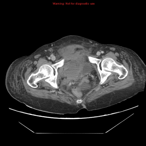File:Abdominal wall hematoma (Radiopaedia 9427-10112 Axial C+ portal venous phase 104).jpg