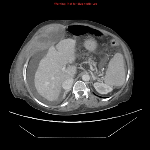File:Abdominal wall hematoma (Radiopaedia 9427-10112 Axial C+ portal venous phase 31).jpg