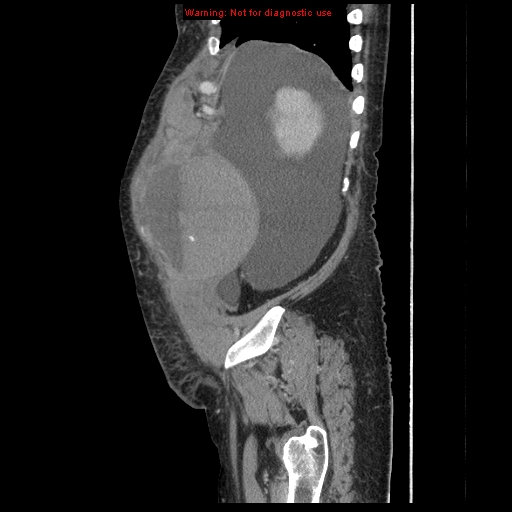 Abdominal wall hematoma (Radiopaedia 9427-10112 Sagittal C+ portal venous phase 91).jpg