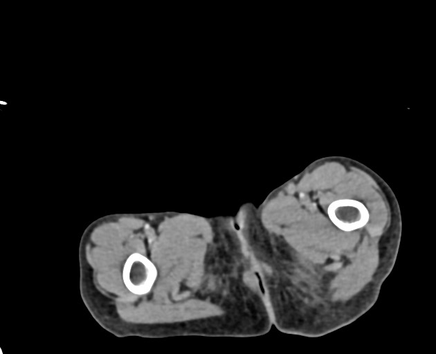 Abdominopelvic rhabdomyosarcoma (Radiopaedia 78356-90984 Axial C+ portal venous phase 167).jpg