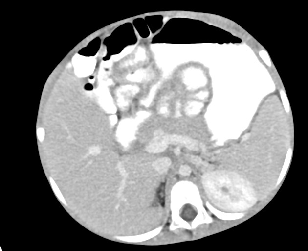 Abdominopelvic rhabdomyosarcoma (Radiopaedia 78356-90984 Axial C+ portal venous phase 59).jpg