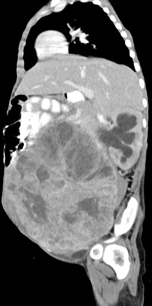 Abdominopelvic rhabdomyosarcoma (Radiopaedia 78356-90984 Sagittal C+ portal venous phase 61).jpg