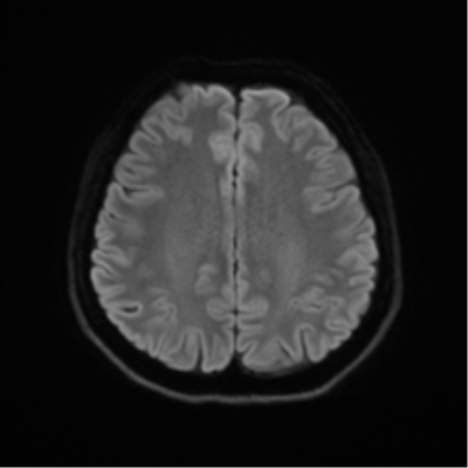 Abducens nerve palsy (Radiopaedia 51069-56648 Axial DWI 45).png