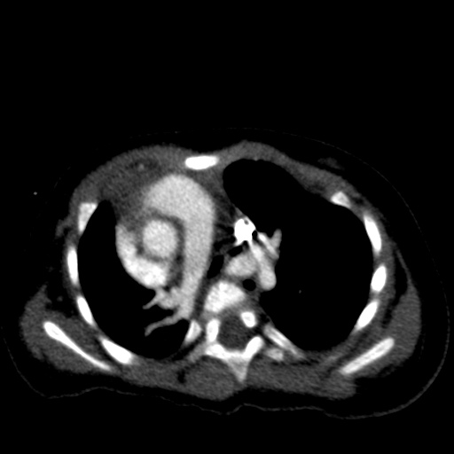 Aberrant left pulmonary artery (pulmonary sling) (Radiopaedia 42323-45435 Axial C+ CTPA 20).jpg