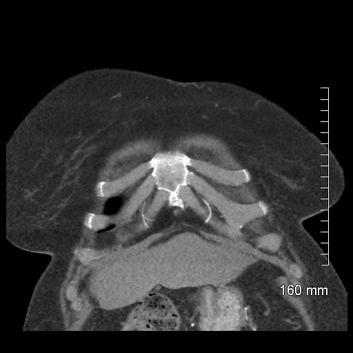 Aberrant right subclavian artery stenosis (Radiopaedia 52656-58670 B 17).jpg