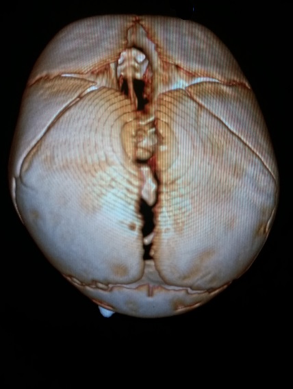 File:Accessory intraparietal suture (Radiopaedia 50584-56021 3D reconstruction 5).jpg