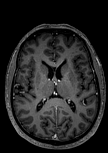 Accessory middle cerebral artery (Radiopaedia 73114-83828 Axial T1 C+ 14).jpg