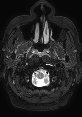 Accessory middle cerebral artery (Radiopaedia 73114-83828 Axial T2 223).jpg
