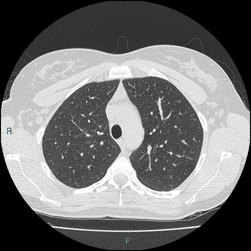 File:Accidental foreign body aspiration (seamstress needle) (Radiopaedia 77740-89983 Axial lung window 19).jpg