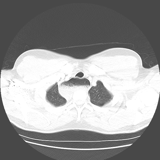 Achalasia (Radiopaedia 52507-58417 Axial lung window 8).jpg