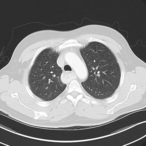 Achalasia of the cardia (Radiopaedia 38497-40595 Axial lung window 16).png
