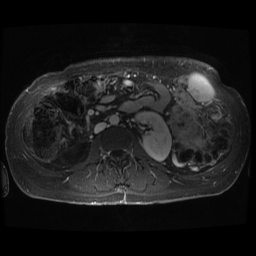 Acinar cell carcinoma of the pancreas (Radiopaedia 75442-86668 D 17).jpg
