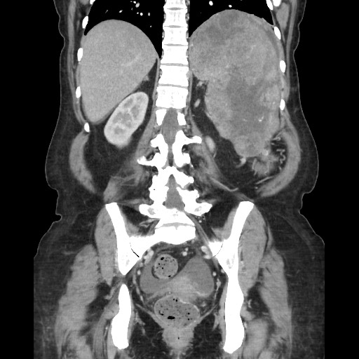Acinar cell carcinoma of the pancreas (Radiopaedia 75442-86669 Coronal C+ portal venous phase 90).jpg