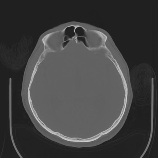 File:Acoustic schwannoma (Radiopaedia 29488-29982 AXIAL BONE THICK non-contrast 23).jpg
