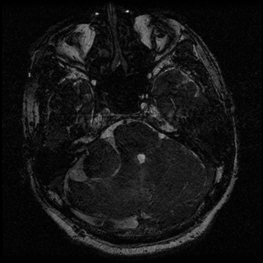 File:Acoustic schwannoma (Radiopaedia 39170-41387 Axial FIESTA 77).png