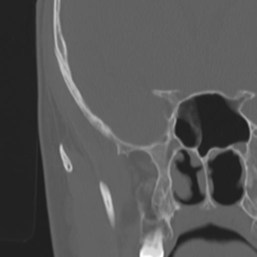 Acoustic schwannoma - eroding petrous apex (Radiopaedia 39674-42002 Coronal bone window 25).png