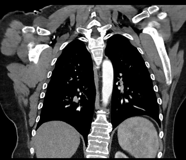Acromioclavicular joint cyst (Radiopaedia 58455-65610 Coronal C+ arterial phase 99).jpg