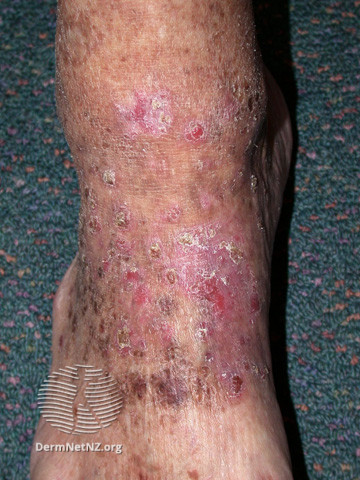 File:Actinic keratoses affecting the legs and feet (DermNet NZ lesions-ak-legs-469).jpg