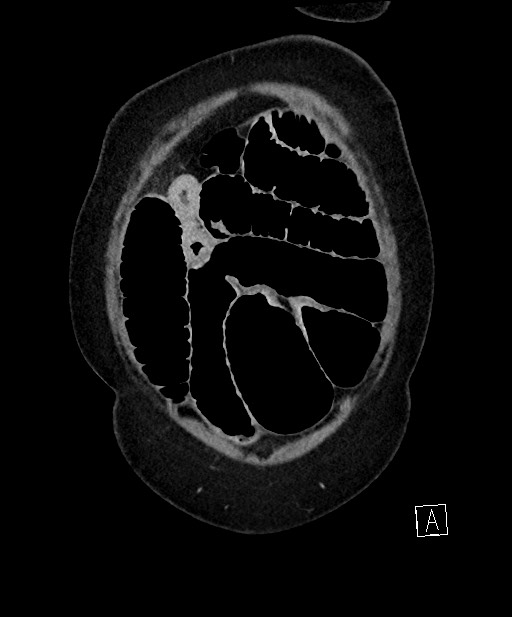 Active Crohn disease (Radiopaedia 59394-66750 Coronal C+ portal venous phase 14).jpg