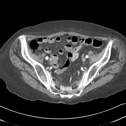 File:Active bleeding from duodenal ulcer with embolization (Radiopaedia 34216-35481 C 51).png
