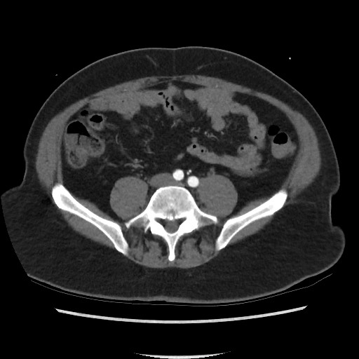 Active colonic bleed on CT (Radiopaedia 49765-55025 Axial C+ arterial phase 54).jpg