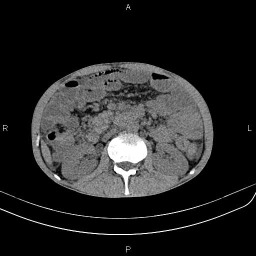 Active crohn disease (Radiopaedia 87133-103397 Axial non-contrast 43).jpg