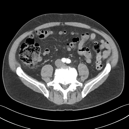 File:Active diverticular hemorrhage (Radiopaedia 39415-41725 Axial C+ arterial phase 42).png