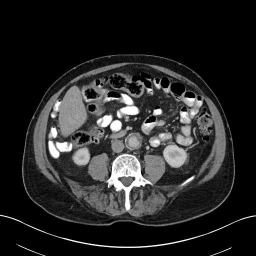 File:Active lower gastrointestinal bleeding - diverticular (Radiopaedia 61203-69106 Axial C+ portal venous phase 71).jpg