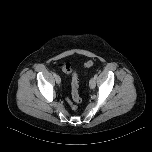 Acute-on-chronic pancreatitis (Radiopaedia 67286-76656 Axial C+ portal venous phase 70).jpg