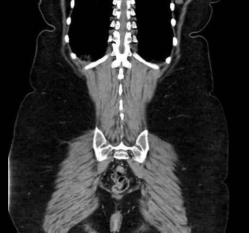 Acute appendicitis, heterotaxy syndrome (Radiopaedia 66884-76202 Coronal C+ portal venous phase 105).jpg