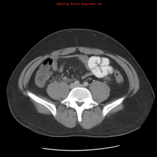 File:Acute appendicitis (Radiopaedia 10498-10973 Axial C+ portal venous phase 16).jpg