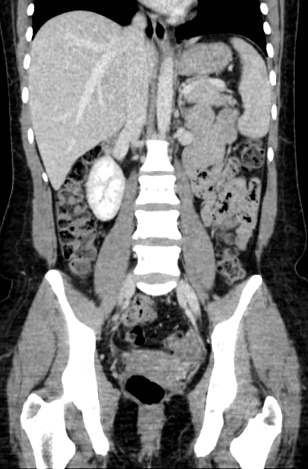 Acute appendicitis (Radiopaedia 22892-22918 Coronal C+ portal venous phase 31).png