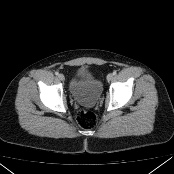 Acute appendicitis (Radiopaedia 38255-40270 Axial C+ portal venous phase 101).jpg