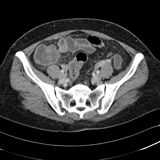 File:Acute appendicitis (Radiopaedia 48792-53822 Axial C+ portal venous phase 87).jpg